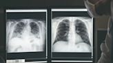 Descubren por qué muchos pacientes con cáncer de pulmón que nunca han fumado tienen peor pronóstico de la enfermedad