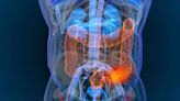 Cada vez más adultos menores de 55 años padecen cáncer de colon