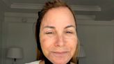 “RHONY's ”Jill Zarin, 60, Underwent 'Facial Rejuvenation' Surgery to Address Her 'Jowling, Sagging Neck Skin', Doc Says