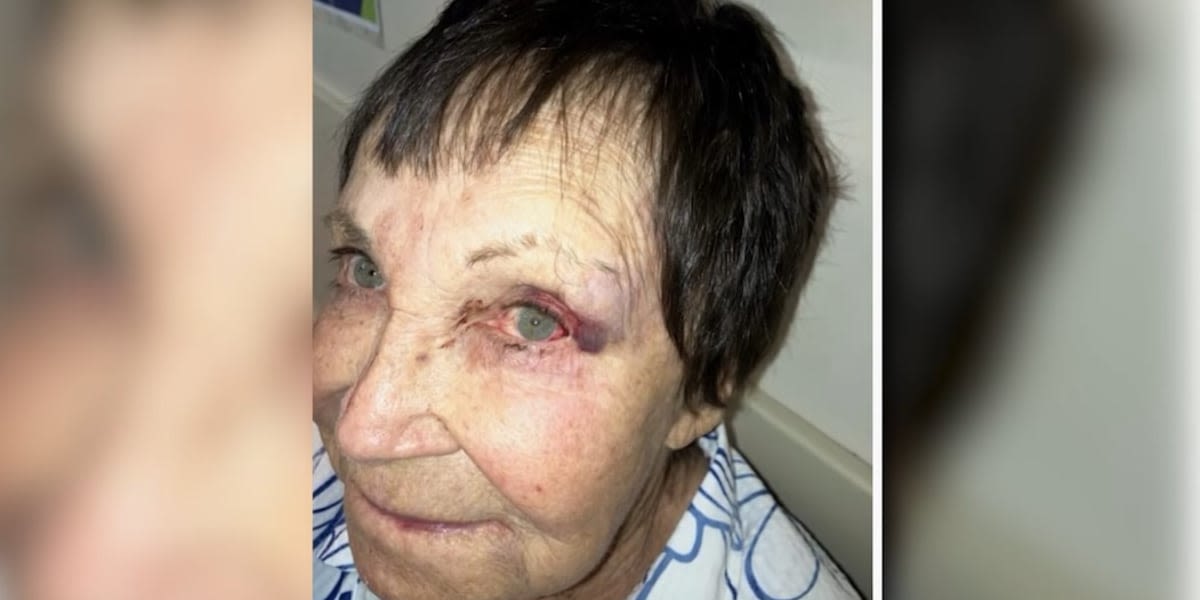 89-year-old comedian feared she would lose her eye after she was sucker-punched