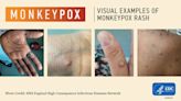 9 things Texans need to know about monkeypox — from transmission to vaccination