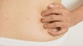 Itchy Hives on Stomach: Causes, When It's Serious, and How to Fix It