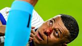 'Any Ideas for Masks': Kylian Mbappe Shares First Reaction After Suffering Broken Nose In France's Euro 2024 Opener - News18