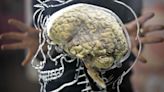 Rare genetic mutation ‘could help stave off early-onset Alzheimer’s’