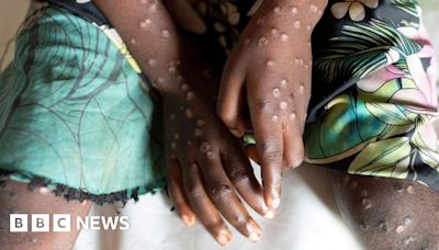 Mpox in Africa: New strain declared a continental public health emergency