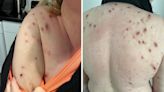 Furious mum says she has accidentally given her whole family scabies