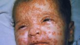 Will Destruction Of Smallpox Virus Get Postponed Again?