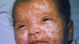 Will Smallpox Virus Get Another Stay Of Execution? Does It Matter?