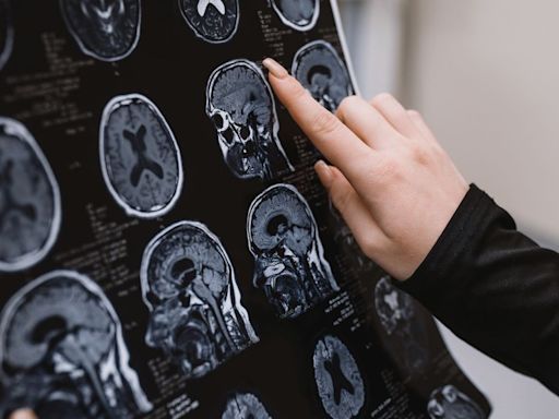 Alzheimer’s Disease With No Symptoms? 12 Very Unusual Cases Are Showing How