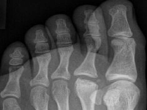 Si tienes el segundo dedo del pie más largo que el gordo podrías padecer esta enfermedad