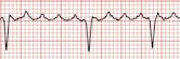 Atrial flutter