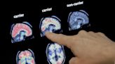 VA to Cover New Drug for Early Stage Alzheimer's Disease