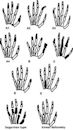 Brachydactyly