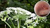 Giant hogweed: How to identify plant that causes burns and blisters