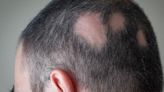 Microneedle Patches Might Reverse a Form of Hair Loss