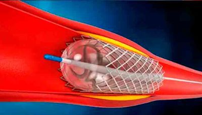 ANGIOPLASTIA, UNA FORMA NO INVASIVA DE ARREGLAR LAS ARTERIAS - El Diario - Bolivia