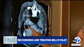 Student issues warning on recognizing signs of Bell's Palsy, a form of facial paralysis