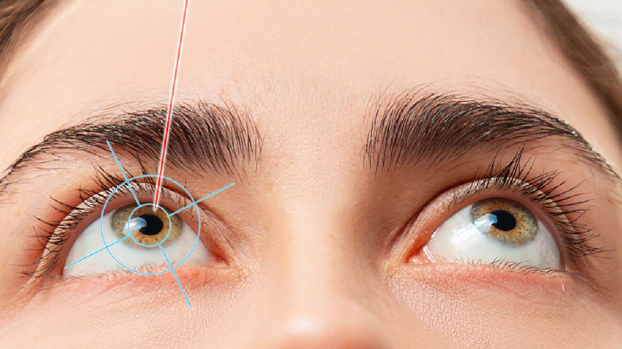 Utah eye surgeon explains what you need to know when thinking about LASIK