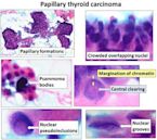 Papillary thyroid cancer