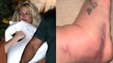 Britney Spears: Foot Injury 'Already Better' After Chateau Marmont