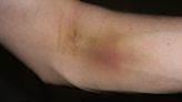 Here's why some people bruise more easily than others