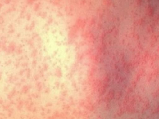 Passenger on United flight to Fresno had measles, officials confirm