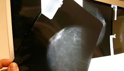 Un estudio cuestiona el dogma sobre cómo surgen la mayoría de los cánceres de mama