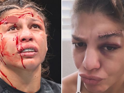 UFC star reveals gruesome scar after suffering gaping gash 'down to the bone'