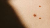 Is that mole melanoma? How to tell if a mole is cancerous or not