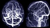 Statins, Metformin Can Cut Odds for Brain Aneurysms