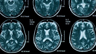 Pfizer, BMS and more to take part in FNIH Parkinson’s biomarker project