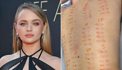 Joey King Shares Results of Allergy Test — and She's Pretty Much Allergic to Everything