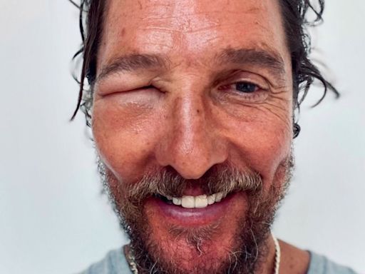 Matthew McConaughey sufre una picadura de abeja que le dejó la cara completamente hinchada