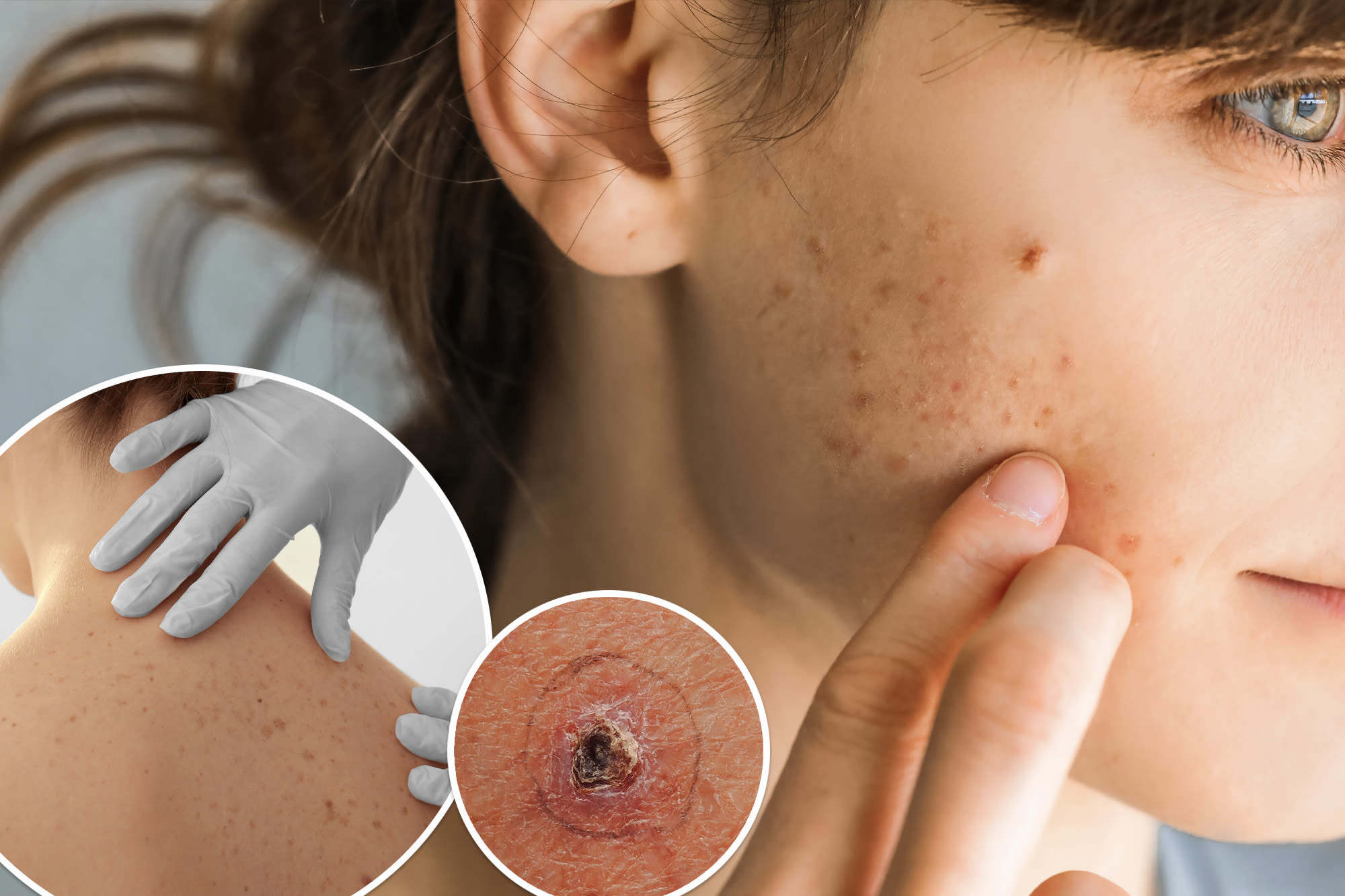 When your pimple might be cancer — and how to recognize the signs