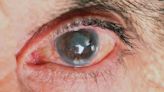 Stiff Arteries Raise Glaucoma Risk?