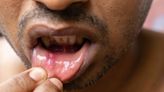 What Are Canker Sores?