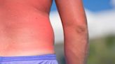 One sign means your sunburn is serious and you need urgent help