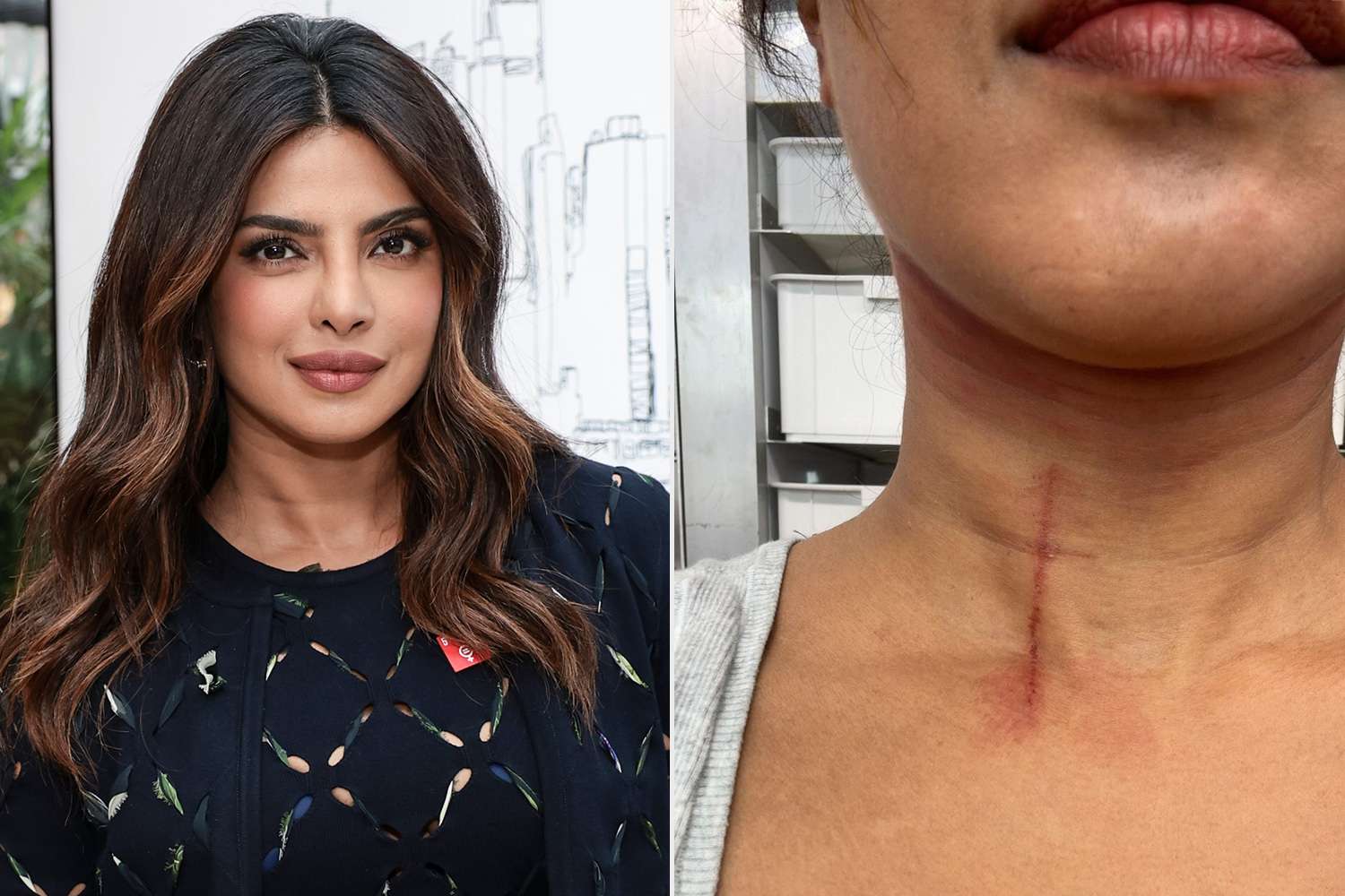 Priyanka Chopra Shares Image of Neck Cut Suffered Doing Stunts on New Movie: ‘Hazards on My Jobs’