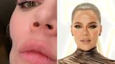 Khloé Kardashian Opens Up About Cheek Indentation Left by Melanoma Spot: ‘I Am Not Complaining’