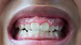 What to Know About Tooth Erosion to Protect Your Smile