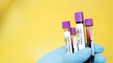 Panel recommends blood test to detect colon cancer for FDA approval - UPI.com