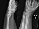 Smith's fracture