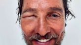 Matthew McConaughey Shocks Fans with His Swollen Eye: 'Bee Swell'