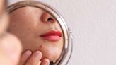 Is Your Skin Purging or Breaking Out? Dermatologists Explain How to Tell