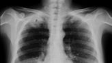 6 mil brasileiros que nunca fumaram podem ter diagnóstico de câncer de pulmão