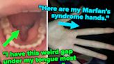 Marfan's Syndrome, Mandibular Tori, And 17 More Really Interesting Body Abnormalities People Are Proudly Sharing