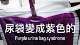 小便居然是紫色的！ 醫揭「紫尿症」真相與3件事有關