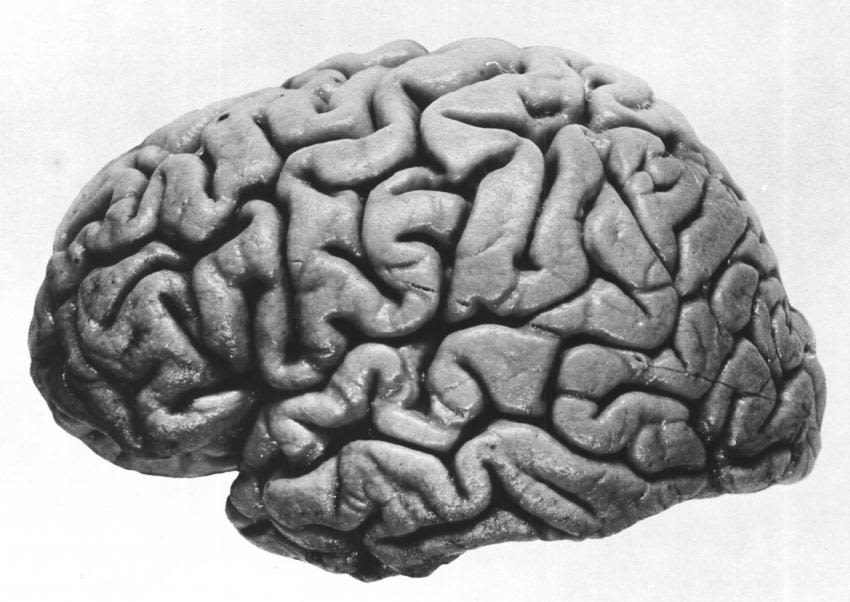 RFK Jr. says a parasite ate part of his brain. Do parasites actually 'eat' human tissue?