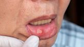 常常嘴破，可能不只是火氣大，恐為免疫問題警訊，引發口腔潰瘍6原因