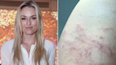 Lindsey Vonn Reveals She Was 'Stung by a Massive Jellyfish': 'How Concerned Should I Be?!'